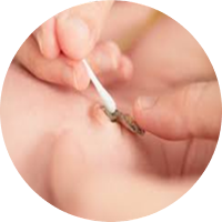 Köldökcsonk kezelése